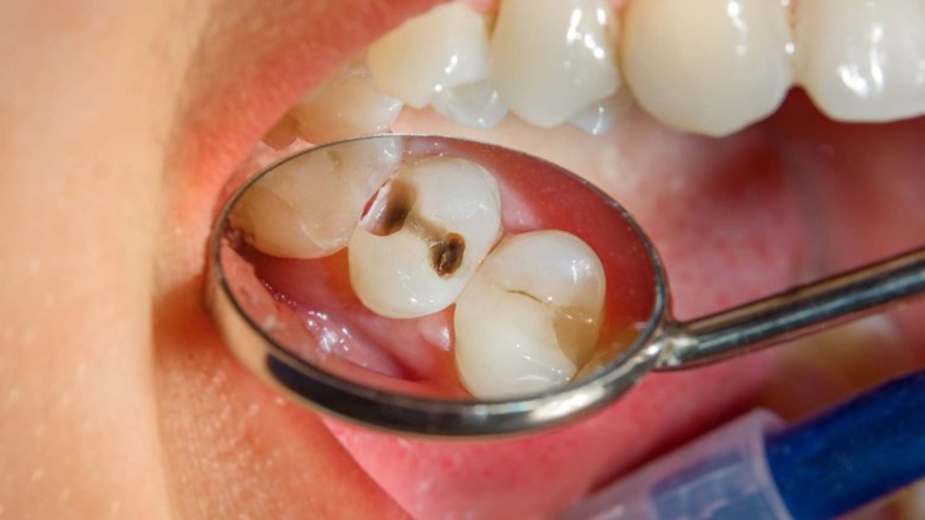 dental-caries-risk-pandemic-780x439