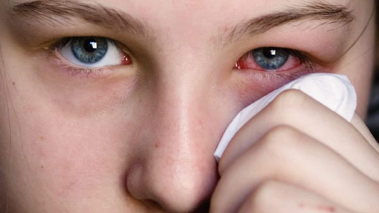 1800ss_istock_photo_of_woman_holding_tissue_to_reddened_eye-780x439